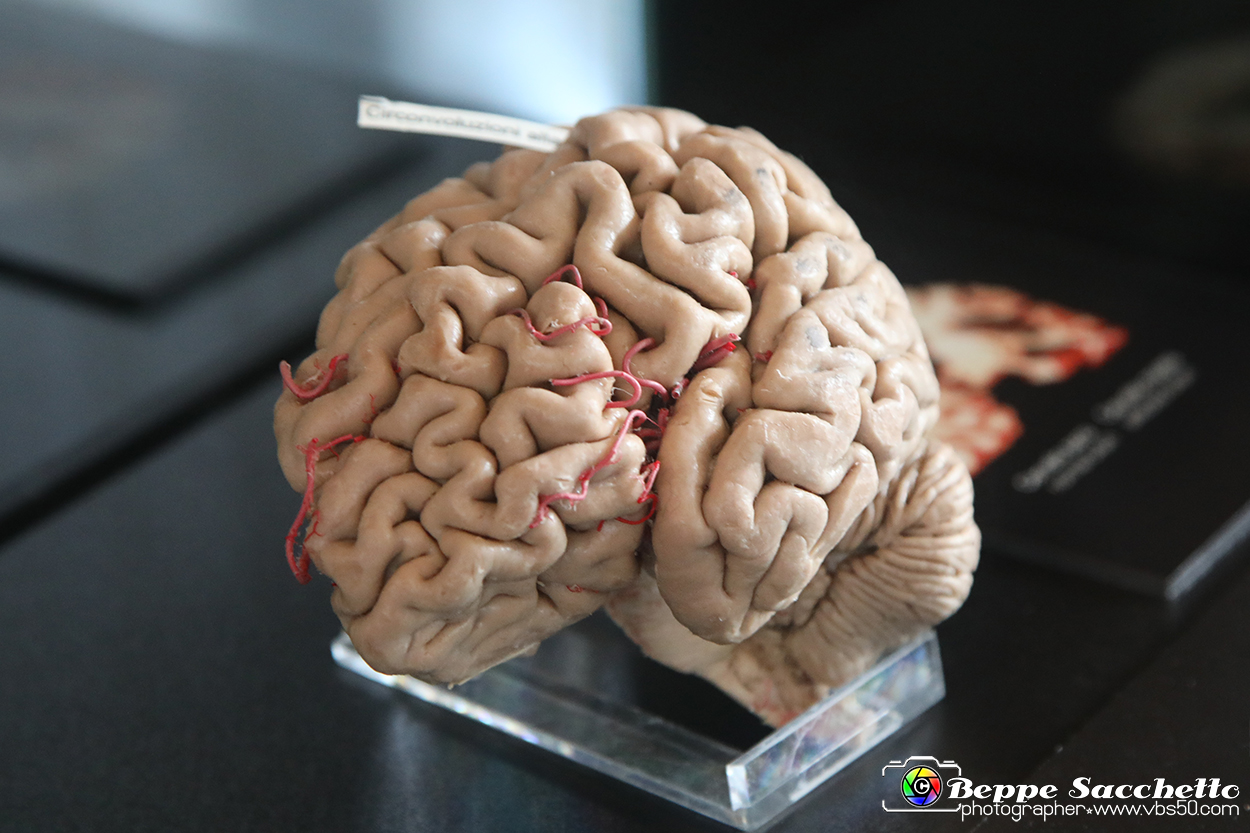 VBS_2946 - Cervello. Morbo di Alzheimer - Mostra Body Worlds.jpg